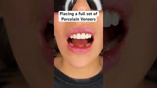 Placing a full set of Porcelain Veneers dentist dentalmakeover porcelainveneers [upl. by Krissy]