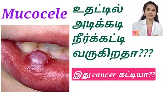 உதட்டில் அடிக்கடி நீர்க்கட்டி வருகிறதாMucocele tamil natpudandoctor6080 [upl. by Noterb625]