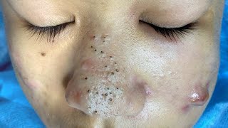 Big Cystic Acne Blackheads Extraction Blackheads amp Milia Whiteheads Removal Pimple Popping  1210 [upl. by Anivlac]