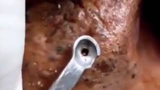 Top 5 Biggest Blackhead on the world  Blackheads Removal 2019 21 [upl. by Millda]