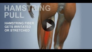 Common Sports Injuries Hamstring Pull [upl. by Akenet]