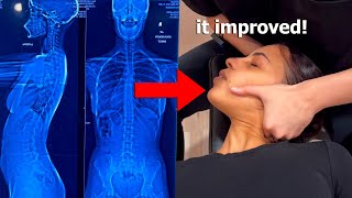 ASMR Chiropractor Adjusts my Scoliosis with Neck and Back Cracks [upl. by Susi382]