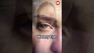 Symptoms of eye strain part 2 wait for part 3 Swaineyeclinic headache eye pain irritating eye [upl. by Mansur912]