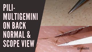 Tweezist Pilimultigemini removal from back normal and scope view [upl. by Noelopan522]