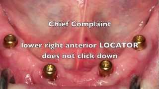 NEW Locator Dental Implant Attachments  Workshop Tips [upl. by Cottrell]