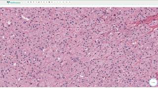 Renal Oncocytoma  Histopathology [upl. by Maximo]