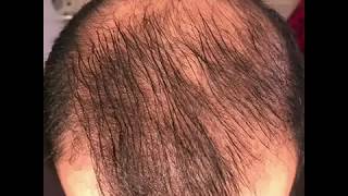 8 months using minoxidil  Rogaine 5 Before amp After results [upl. by Schug]