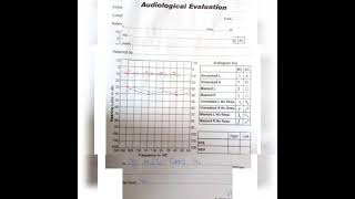 Audiological Evaluation Audiogram conductivemixed SNHL hearing Losstypes of Hearing Loss। [upl. by Rajewski]