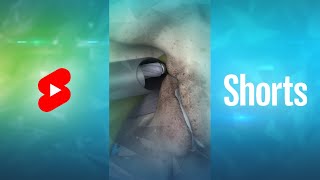 What is Endoscopic Lumbar Foraminotomy Shorts [upl. by Elay423]