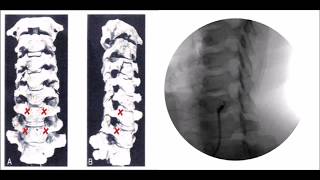 How to perform Stellate Ganglion Block Treatment [upl. by Esenaj565]