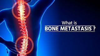 What is bone metastasis  Stage 4 Cancer  Bone Metastasis  How Cancer Spreads  metastasis [upl. by Reagen108]