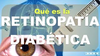 ¿Qué es la RETINOPATÍA diabética Causas Diagnóstico clínica oftalmoscopía Parte 1 [upl. by Smiga]