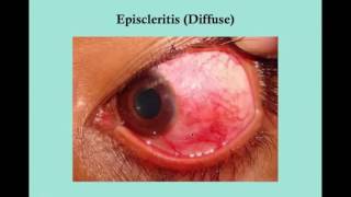 Scleritis and Episcleritis CRASH USMLE Step 2 and 3 [upl. by Joby]