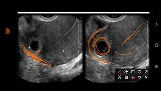 interstitial Ectopic pregnancy [upl. by Liahcim]