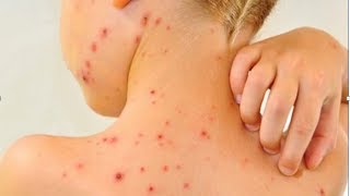 How To Cure Scabies Natural Itch Relief For Scabies What Is Scabies Rash Natural Cure [upl. by Fabriane]