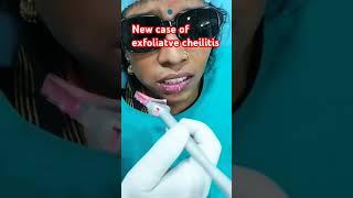 New case of exfoliatve cheilitis treated by Laser [upl. by Notrom]