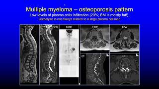 Multiparametric imaging of bone marrow metastatic disease Anwar Padhani [upl. by Ocihc]