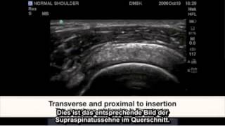 Fallstudie FujiFilm SonoSite Pathologie der Supraspinatussehne [upl. by Oslec]