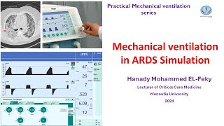 Simulation of Ventilator settings in ARDS in Arabic [upl. by Bogey]