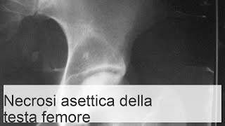 Fasi della necrosi asettica della testa del femore segni radiologici e fasi di trattamento [upl. by Esojnauj]