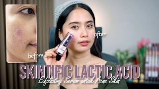 Review SKINTIFIC Lactic Acid Pemakaian 2 Minggu di Acne Prone Skin   Before After  No BUMILBUSUI [upl. by Eissolf]