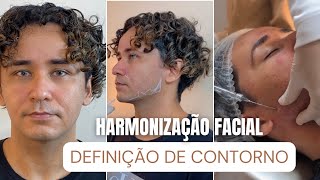 Harmonização Facial Surpreendente Antes e Depois  Transformação com Ácido Hialurônico e Reação [upl. by Valeda]