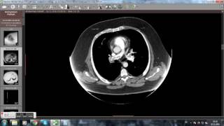 CT Computertomographie Lungenembolie Videoanalyse [upl. by Ainezey406]