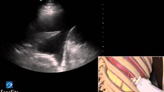 3D Lehrvideo Ultraschallgestütze Thoracentesis Untersuchung  SonoSite Ultraschall [upl. by Doi]