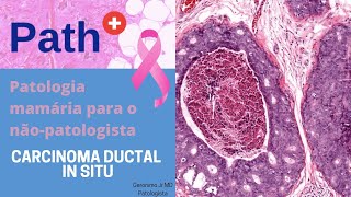 Carcinoma Ductal in situ para o não patologista  Uma atualização [upl. by Aisemaj]