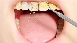 3D Animation of Dental Scaling  How Plaque and Tartar are Professionally Removed [upl. by Lotsirb811]