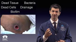 Debridement Myths for Youtube Video [upl. by Druci]