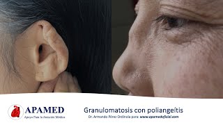 Granulomatosis con poliangeítis Granulomatosis de Wegener y vasculitis asociadas a ANCA [upl. by Nosremaj]