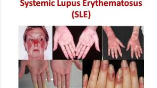 Systemic Lupus Erythematosus  SLE  Causes Signs amp Symptoms  Treatment [upl. by Gentille1]