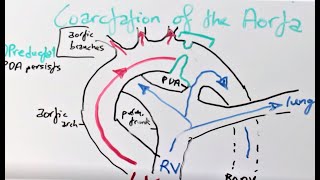 Coarctation of the Aorta Presentation Pathophysiology Diagnosis amp Treatment [upl. by Mutz]