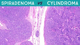 Spiradenoma vs Cylindroma Dermpath in 5 Minutes pathology dermatology dermatopathology sweat gland [upl. by Ennagrom355]