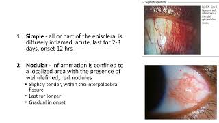 EPISCLERITIS AND SCLERITIS [upl. by Gabrila]