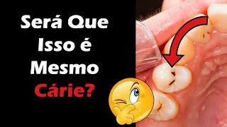 Cárie Dental  3 Sintomas Que Você Pode olhar EM CASA Para Saber se Tem Cárie no Dente [upl. by Maxim]