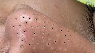 Big Cystic Acne Blackheads Extraction Blackheads amp Milia Whiteheads Removal Pimple Popping  2747 [upl. by Imak323]