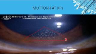 ANTERIOR UVEITISIRIDOCYCLITIS FROM AK KHURANA SIMPLIFIED [upl. by Light842]