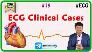 19 ECG Clinical cases [upl. by Nosyt]