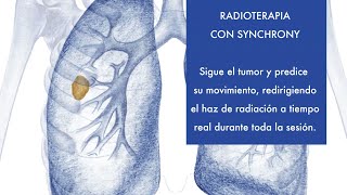 Radioterapia con Synchrony y cáncer de pulmón [upl. by Danna147]