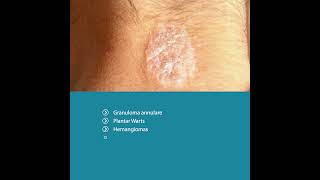 Cryopen Cryosurgery  Treating Benign Skin Lesions [upl. by Krug]