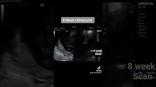 8 week Ultrasound Retroflexed Uterus [upl. by Eioj493]