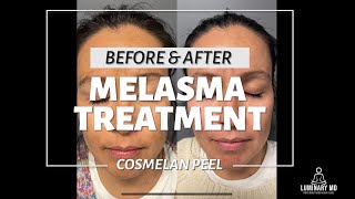 Cosmelan Peel for Melasma in Orange County with Results [upl. by Kingsley]