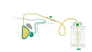 Suprapubic Catheter How to use [upl. by Salas295]