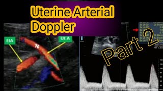 Obstetrics Doppler ultrasoundUterine artery Doppler ultrasound [upl. by Aketahs]