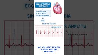 Diagnostics on Demand Cardiac tamponade [upl. by Elvah]