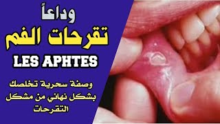 وداعا les aphtes وداعا تقرحات الفم [upl. by Anairuy]