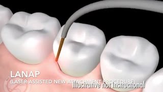 How Does Laser Surgery Work Treat Gum Disease  LANAP [upl. by Anayeek477]