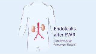 Endoleaks after Endovascular Repair of Thoracic Aortic Aneurysms EVAR [upl. by Regor560]